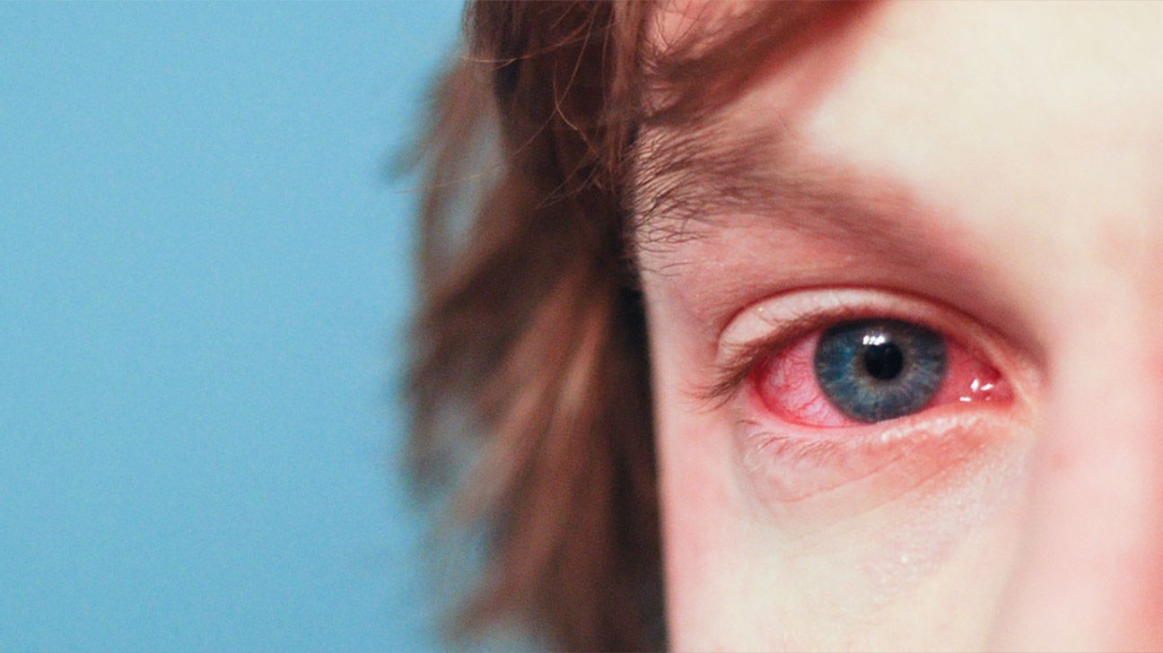 Tìm hiểu về bệnh đau mắt đỏ